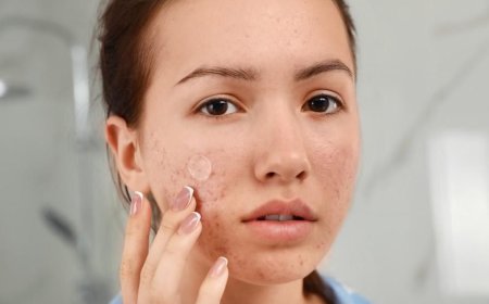 Struggling with Acne and Pimples? Discover Powerful Natural Remedies for Clear Skin at Home