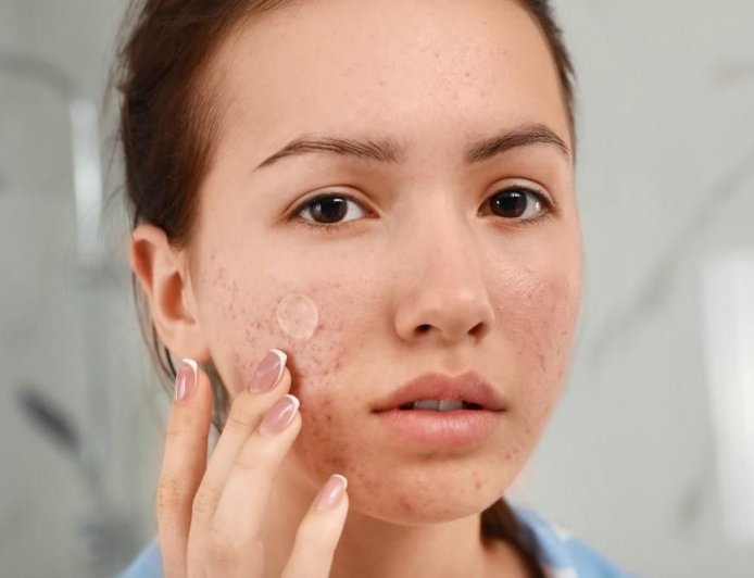 Struggling with Acne and Pimples? Discover Powerful Natural Remedies for Clear Skin at Home