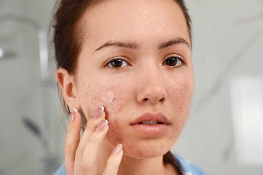 Struggling with Acne and Pimples? Discover Powerful Natural Remedies for Clear Skin at Home